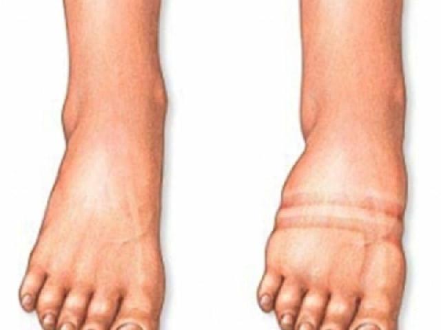 Ayaqlarda şiş yaranmasının səbəbləri – MÜALİCƏ ÜSULU