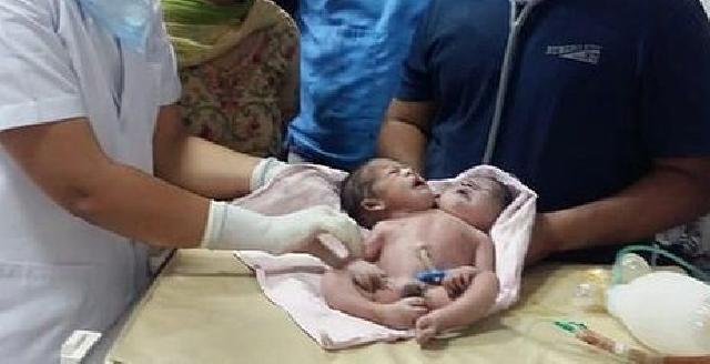 İki başlı uşaq doğuldu - FOTO