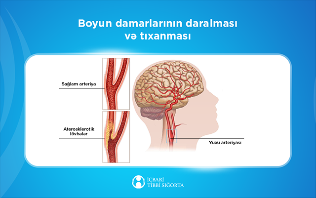 Bu müalicə də icbari tibbi sığortaya daxildir